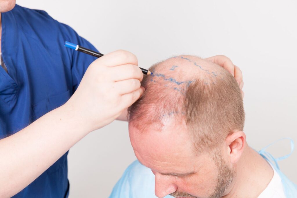 Hair Transplant Services Market Recent Growth and Trends in 2022 to 2030 | Top Key Players are LaserCap, getFUE Hair Clinics, PhotoMedex, Bosley, Ethic