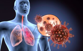 Severe Acute Respiratory Syndrome (SARS) Treatment