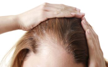 Hair Loss Prevention Products Market