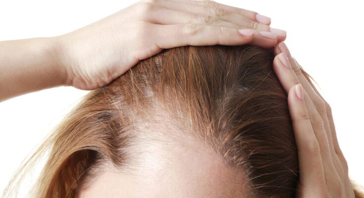Hair Loss Prevention Products Market