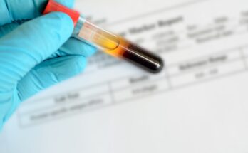 Prostate Specific Antigen (PSA) Testing Market